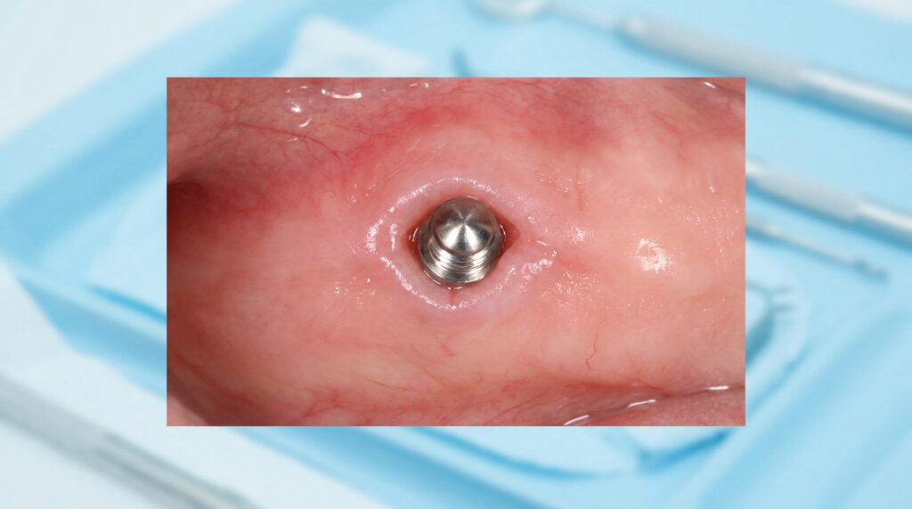 Gros plan intra-oral d'une vis de cicatrisation métallique installée dans la gencive lors d'un traitement implantaire.