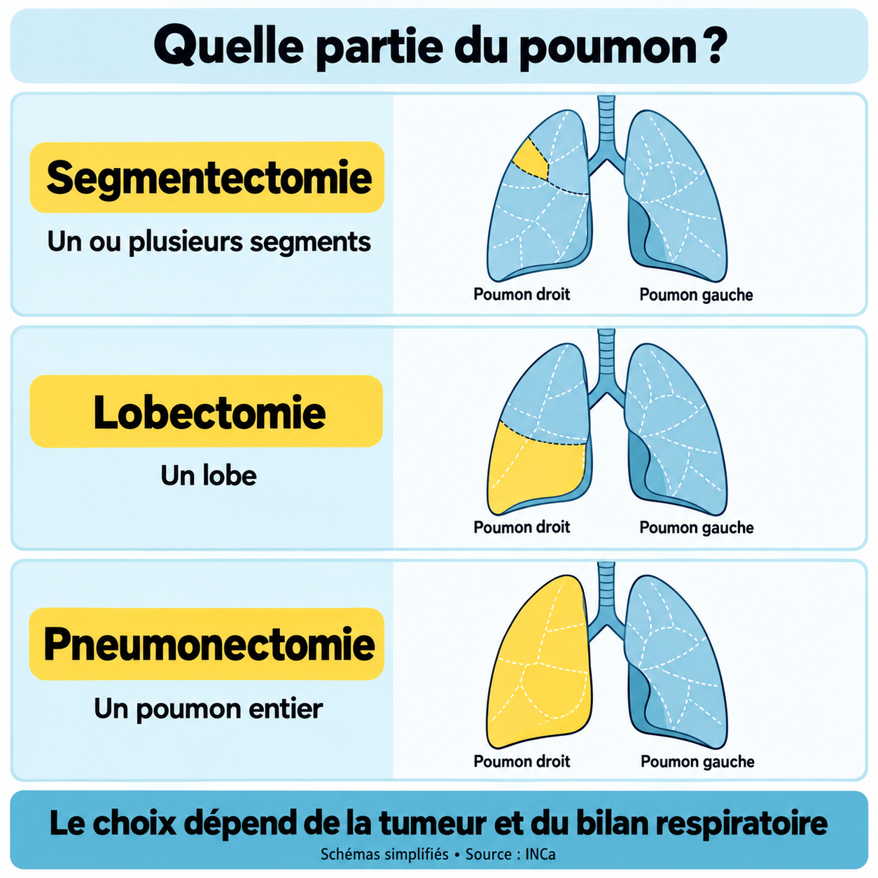 Schémas simplifiés : segmentectomie, un ou plusieurs segments ; lobectomie, un lobe ; pneumonectomie, un poumon entier.